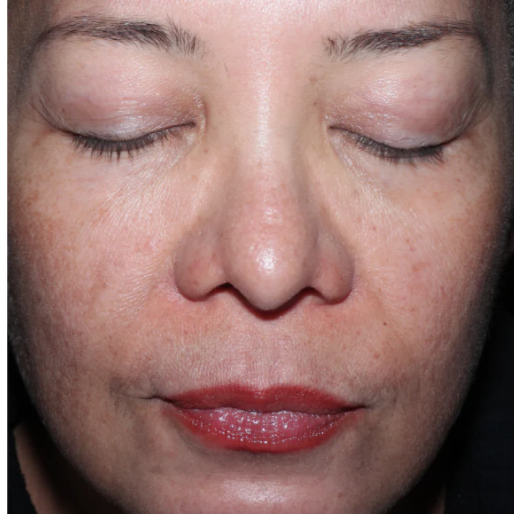 After result - after 16 weeks of ELEVAI enfinity